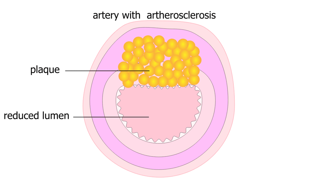 The artery walls have hardened plaque which stiffen the blood vessel